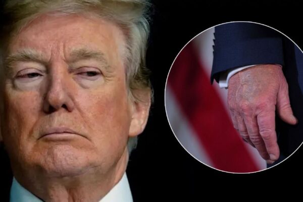 Donald Trump se somete a chequeo médico por hinchazón en las piernas causada por insuficiencia venosa. Foto: cronista