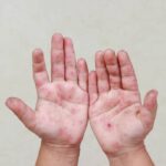 Alerta en 20 municipios de Puebla: 419 alumnos con síntomas de virus Coxsackie. Foto: Síntesis Nacional.