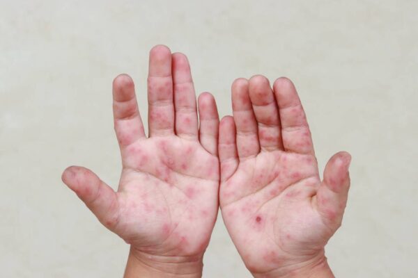 Alerta en 20 municipios de Puebla: 419 alumnos con síntomas de virus Coxsackie. Foto: Síntesis Nacional.