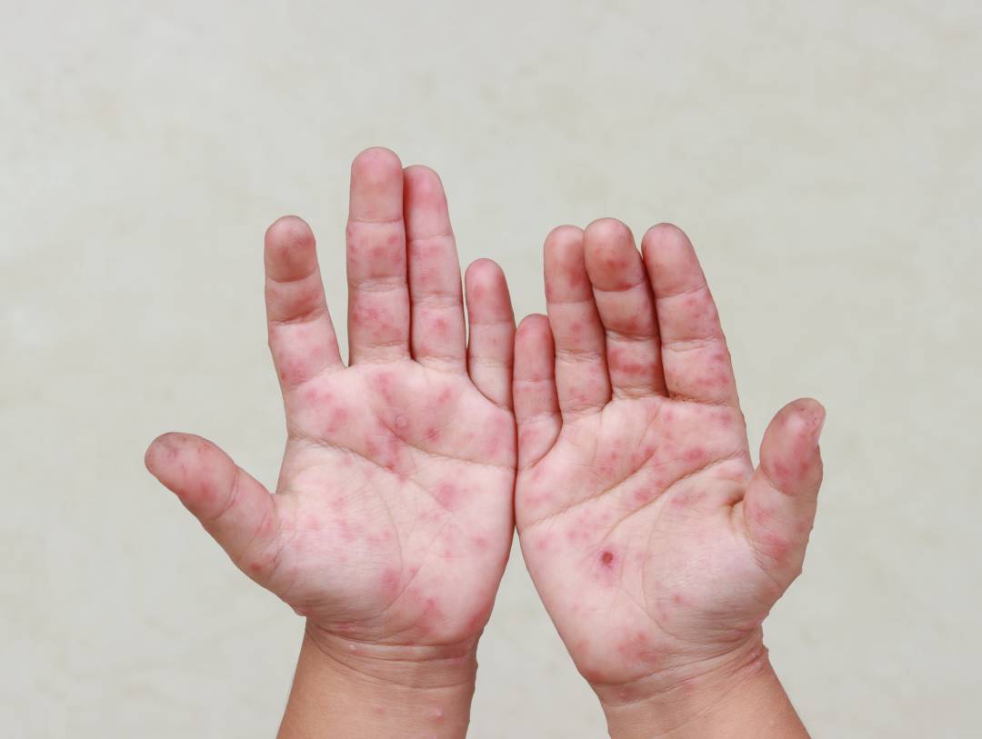 Alerta en 20 municipios de Puebla: 419 alumnos con síntomas de virus Coxsackie. Foto: Síntesis Nacional.