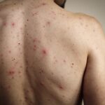 México registró la primera muerte por sarampión en 2026; el deceso ocurrió en Michoacán, en medio de un brote que suma casi mil casos solo en enero. FOTO: El Mundo.