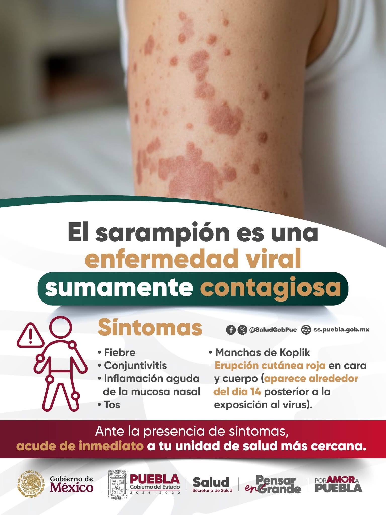 El Ayuntamiento de Texmelucan llamó a la población a reforzar medidas de prevención sanitaria tras un nuevo caso de sarampión en Puebla.