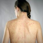 Salud estatal descartó un brote de sarampión en Puebla tras confirmar un caso aislado y activar de inmediato los protocolos sanitarios.