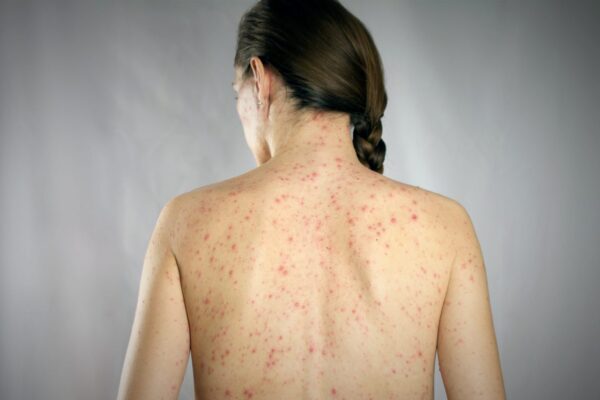 Salud estatal descartó un brote de sarampión en Puebla tras confirmar un caso aislado y activar de inmediato los protocolos sanitarios.