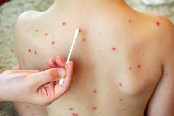 La SS estatal confirmó el cuarto caso de sarampión en el estado. FOTO: Getty Images.