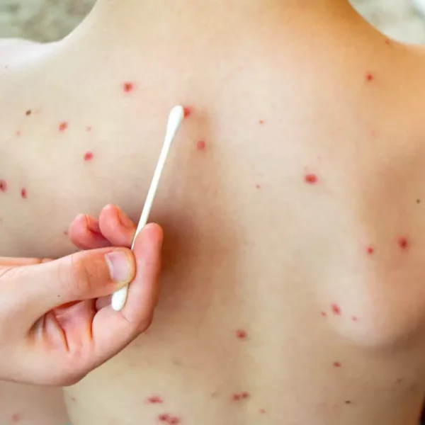 La SS estatal confirmó el cuarto caso de sarampión en el estado. FOTO: Getty Images.