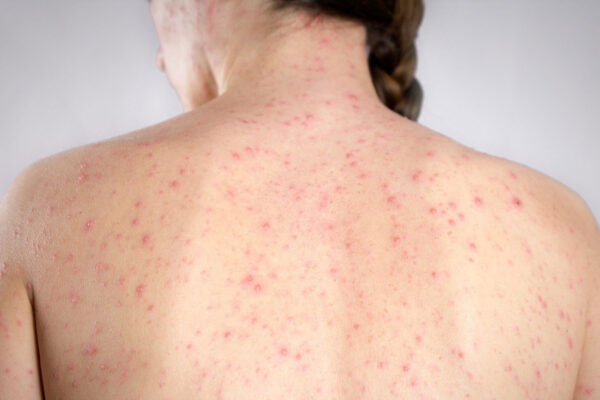 La Secretaría de Salud estatal informó de un caso confirmado de sarampión en una mujer de mediana edad. FOTO: Infobae.