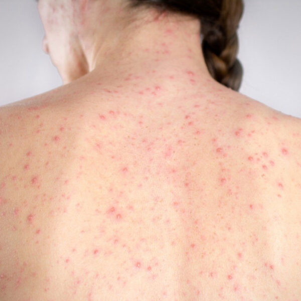 La Secretaría de Salud estatal informó de un caso confirmado de sarampión en una mujer de mediana edad. FOTO: Infobae.