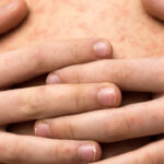 Puebla registra 16 casos confirmados de sarampión en enero de 2026 y mantiene bajo vigilancia 58 contagios probables. FOTO: Fundación UNAM.