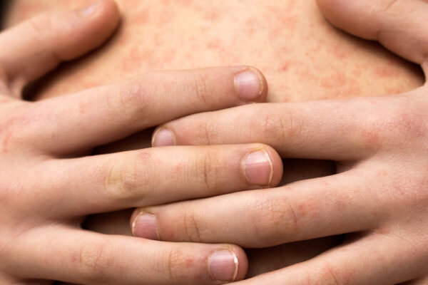 Puebla registra 16 casos confirmados de sarampión en enero de 2026 y mantiene bajo vigilancia 58 contagios probables. FOTO: Fundación UNAM.