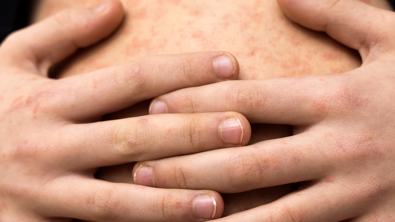 Puebla registra 16 casos confirmados de sarampión en enero de 2026 y mantiene bajo vigilancia 58 contagios probables. FOTO: Fundación UNAM.