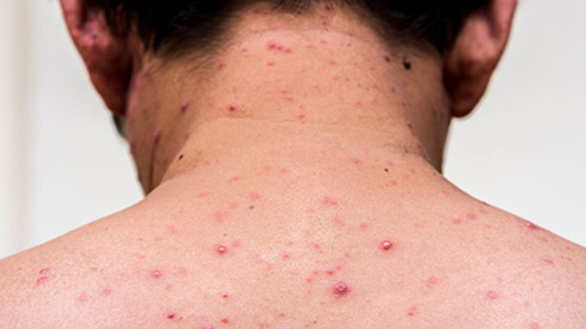 Salud Puebla confirma 44 casos de sarampión; descartan volver al cubrebocas obligatorio