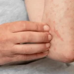 Puebla confirma 33 casos de sarampión; Salud descarta cierre de escuelas y refuerza cercos sanitarios ante el repunte.