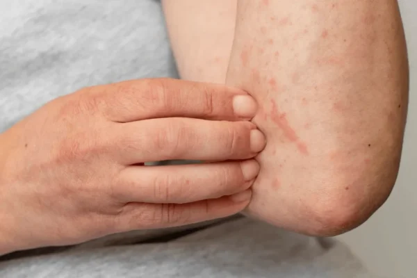 Puebla confirma 33 casos de sarampión; Salud descarta cierre de escuelas y refuerza cercos sanitarios ante el repunte.