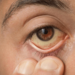 El repunte de casos de hepatitis A en Puebla ha encendido alertas sanitarias tras registrar el mayor número de contagios a nivel nacional.