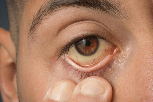 El repunte de casos de hepatitis A en Puebla ha encendido alertas sanitarias tras registrar el mayor número de contagios a nivel nacional.