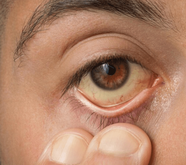 El repunte de casos de hepatitis A en Puebla ha encendido alertas sanitarias tras registrar el mayor número de contagios a nivel nacional.