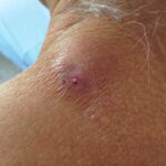 La miasis por gusano barrenador no se transmite entre personas ni puede convertirse en una emergencia sanitaria, aseguró especialista. FOTO: Wikipedia.