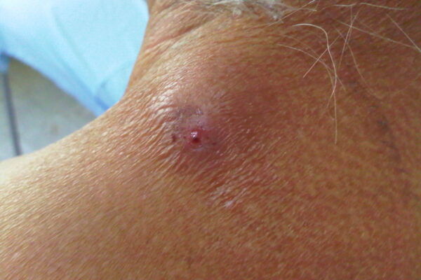 La miasis por gusano barrenador no se transmite entre personas ni puede convertirse en una emergencia sanitaria, aseguró especialista. FOTO: Wikipedia.