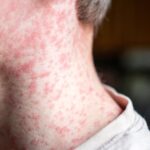 Cuatro casos más de sarampión en una semana reportaron las autoridades sanitarias estatales. FOTO: Getty Images.