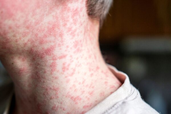 Cuatro casos más de sarampión en una semana reportaron las autoridades sanitarias estatales. FOTO: Getty Images.