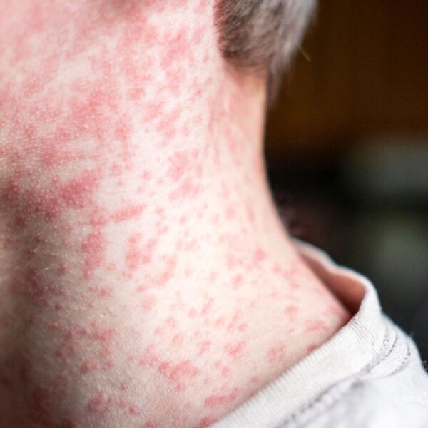 Cuatro casos más de sarampión en una semana reportaron las autoridades sanitarias estatales. FOTO: Getty Images.