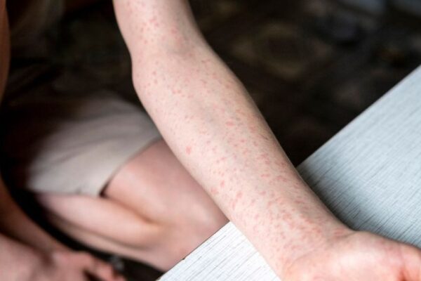 Tras 2 semanas, Puebla reporta 10 casos más registrados de sarampión y la expansión a otros 4 municipios. FOTO: vía BUPA Seguros.