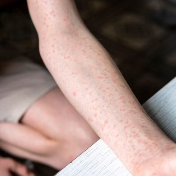 Tras 2 semanas, Puebla reporta 10 casos más registrados de sarampión y la expansión a otros 4 municipios. FOTO: vía BUPA Seguros.