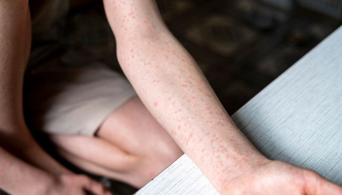 Tras 2 semanas, Puebla reporta 10 casos más registrados de sarampión y la expansión a otros 4 municipios. FOTO: vía BUPA Seguros.